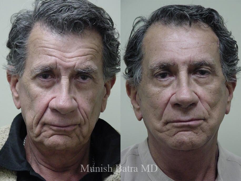 Male Facelift and Neck Lift San Diego Coastal Plastic