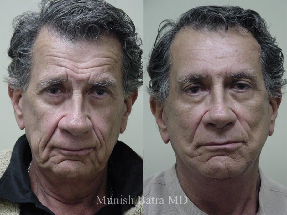 Before and After Image