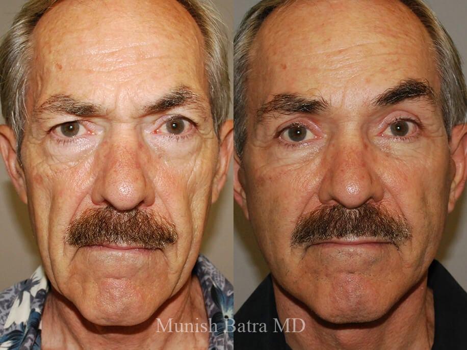 Before and After Image