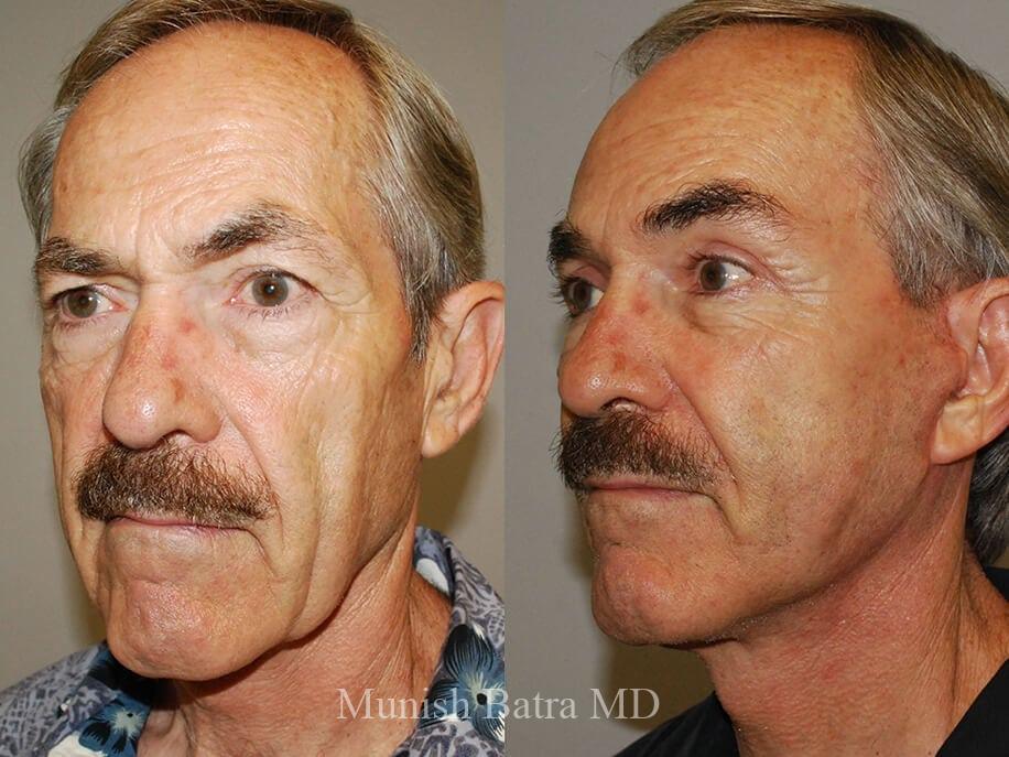 Before and After Image