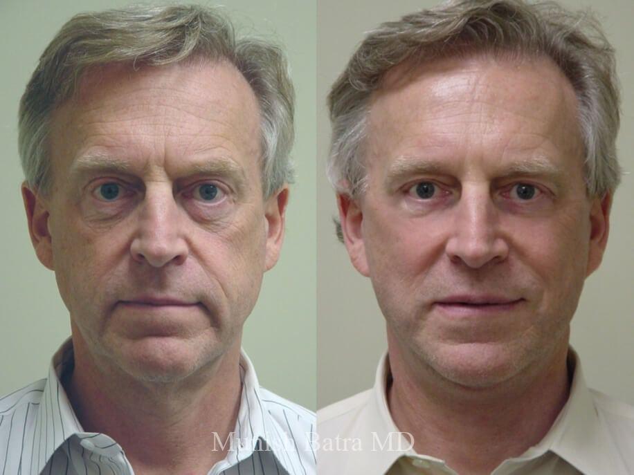 Before and After Image
