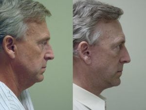 Before and After Image