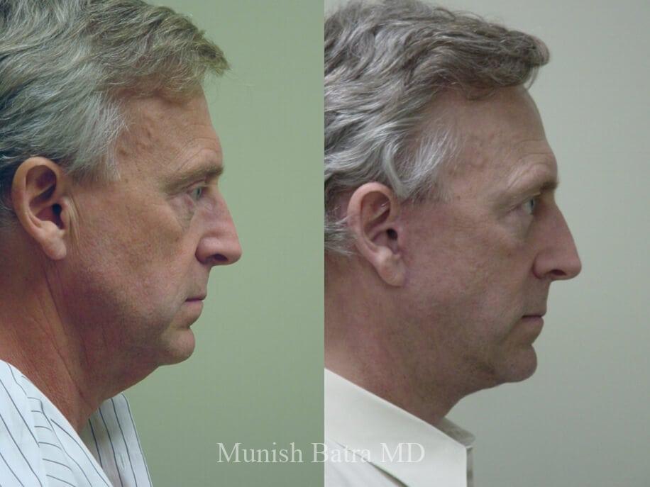 Before and After Image