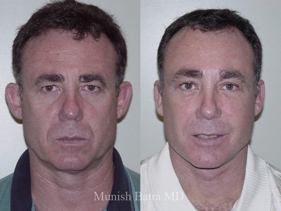 Before and After Image