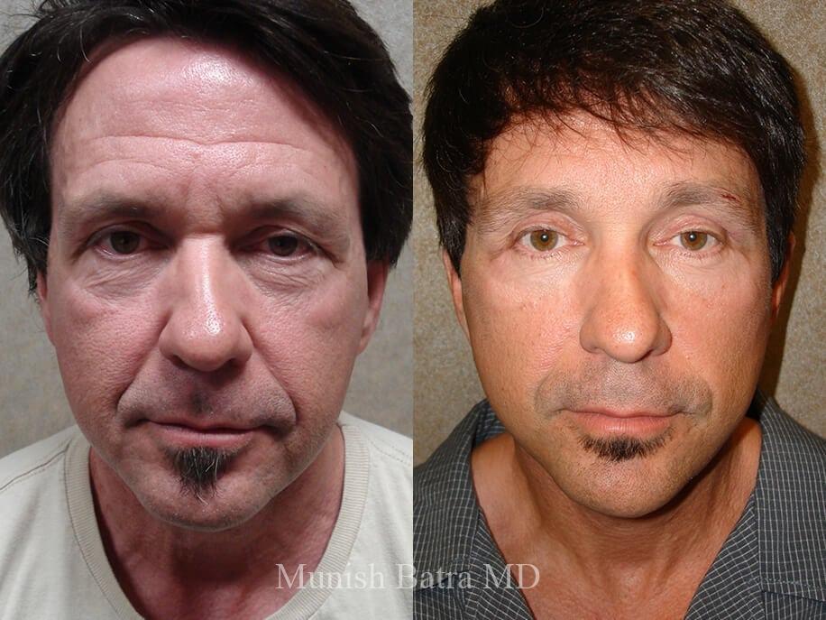 Before and After Image