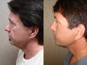 Before and After Image