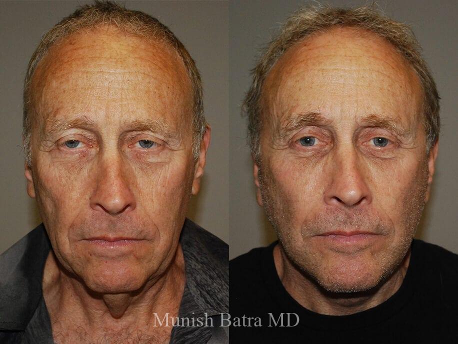 Before and After Image
