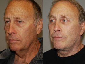 Before and After Image