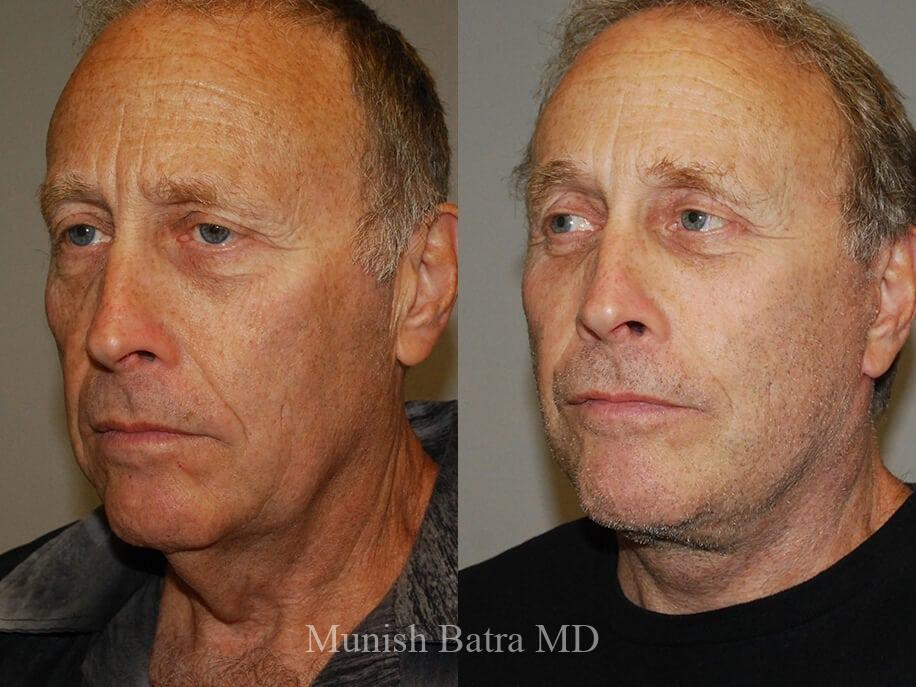 Before and After Image