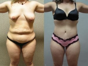 Before and After Image