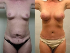 Before and After Image