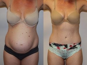 Before and After Image