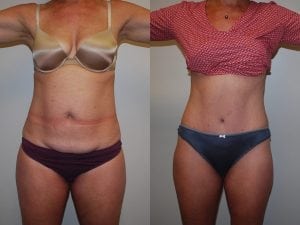 Before and After Image