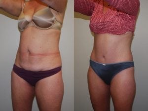 Before and After Image