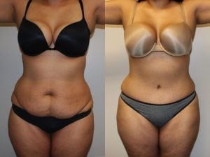 Before and After Image
