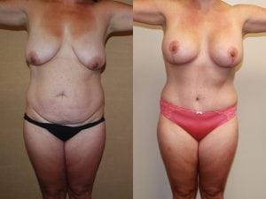 Before and After Image