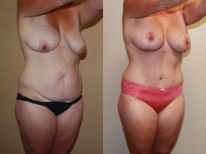 Before and After Image
