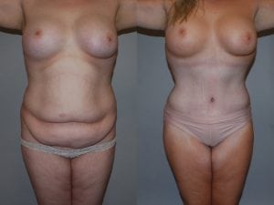 Before and After Image