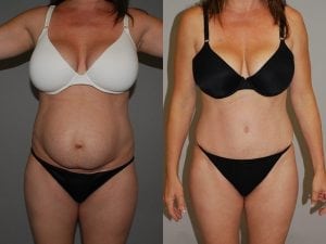 Before and After Image