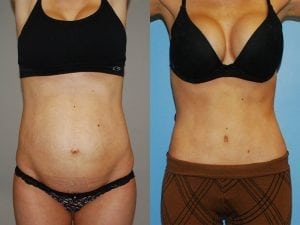 Before and After Image