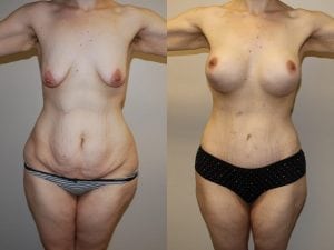 Before and After Image