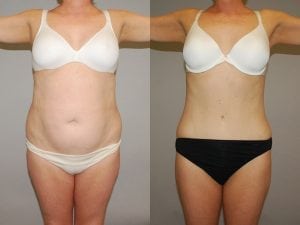 Before and After Image