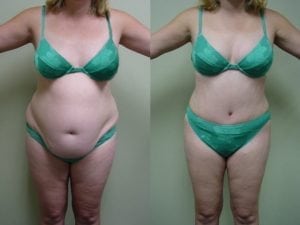 Before and After Image