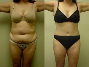 Before and After Image