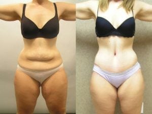 Before and After Image