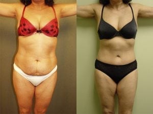 Before and After Image