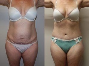 Before and After Image