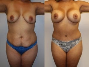 Before and After Image