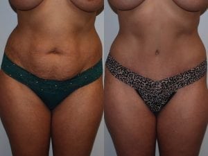 Before and After Image