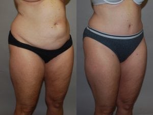 Before and After Image