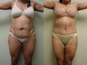 Before and After Image