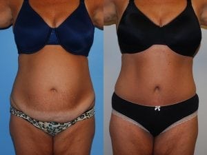 Before and After Image