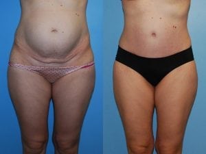 Before and After Image