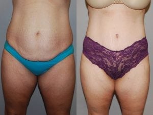 Before and After Image