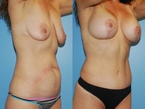Before and After Image