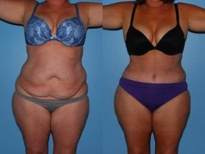 Before and After Image
