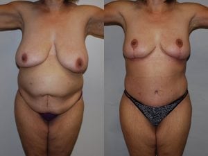 Before and After Image