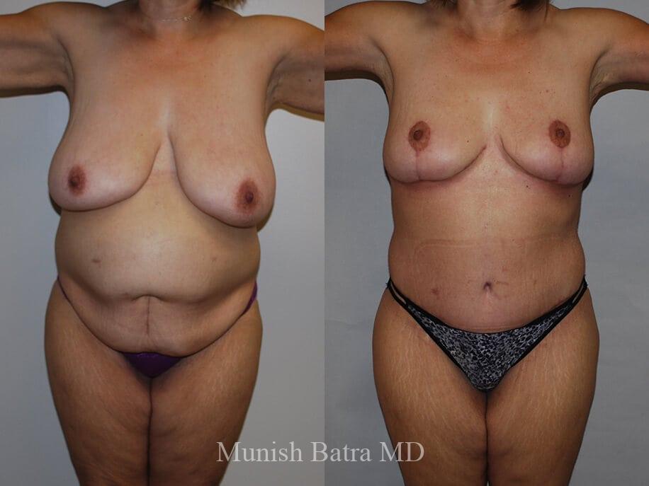 Before and After Image