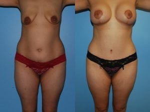 Before and After Image