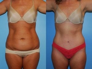 Before and After Image