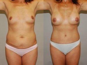 Before and After Image