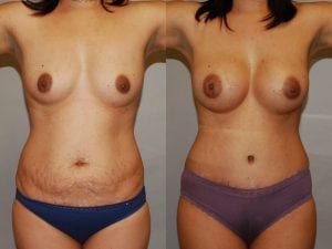 Before and After Image