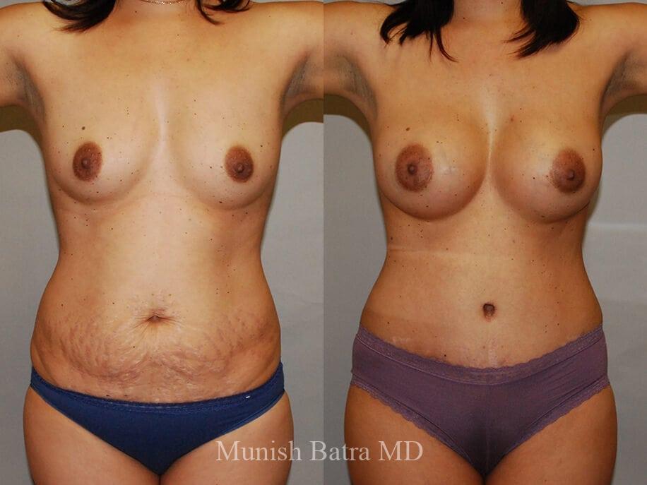 Before and After Image