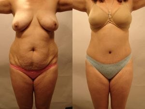 Before and After Image