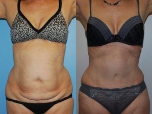 Before and After Image