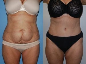 Before and After Image